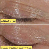 کرم دور چشم اسمارت کلینیک