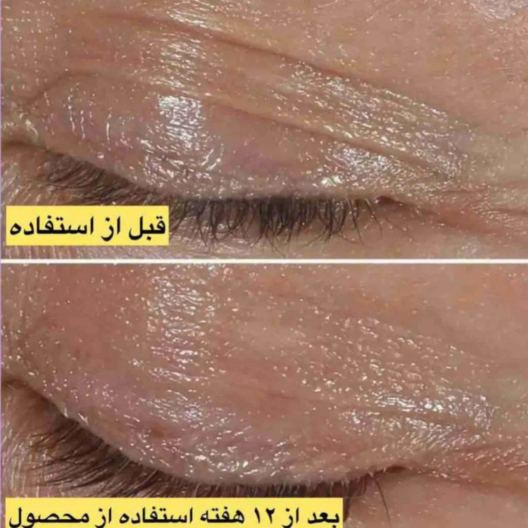 کرم دور چشم اسمارت کلینیک
